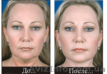 Лазерное омоложение. Лазер СО2 ДОТ(SmartXide DOT)   - <ro>Изображение</ro><ru>Изображение</ru> #1, <ru>Объявление</ru> #384067