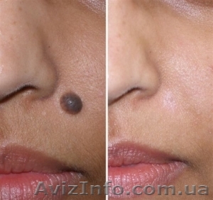 Процедуры коагулятора от Салона красоты "Академия успеха"   - <ro>Изображение</ro><ru>Изображение</ru> #1, <ru>Объявление</ru> #874441