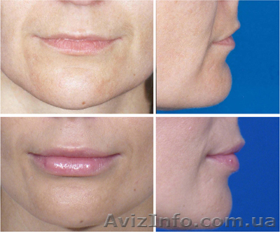 Липофилинг (Увлечение объемов лица и тела, собственными жировыми клетками) - <ro>Изображение</ro><ru>Изображение</ru> #1, <ru>Объявление</ru> #932147