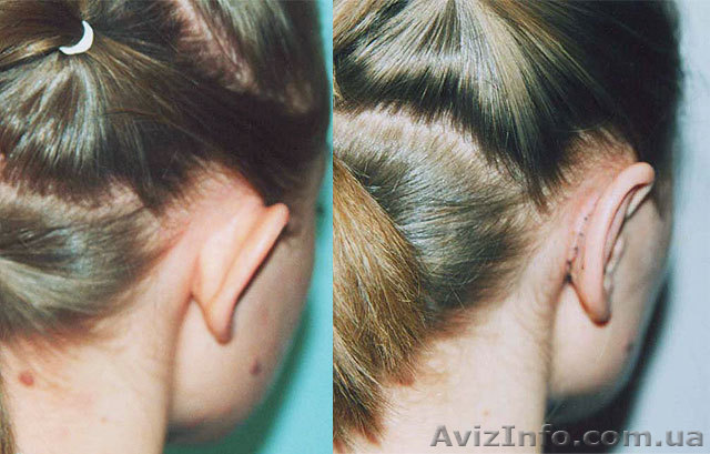 Отопластика (пластика ушей)  - клиника Златадерма - <ro>Изображение</ro><ru>Изображение</ru> #1, <ru>Объявление</ru> #932142